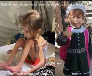Children shot in gaza. A little girl suffering from malnutrition due to starvation.