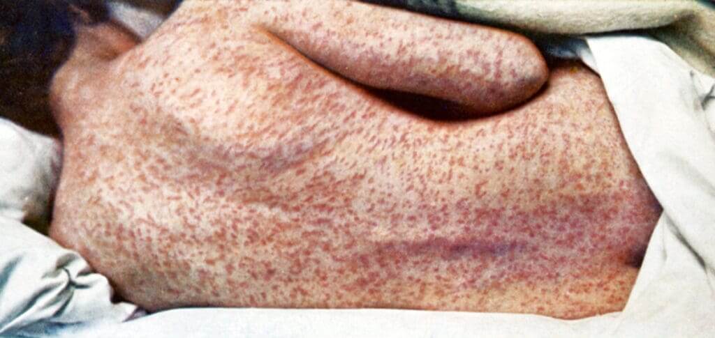 Woman’s back with measles