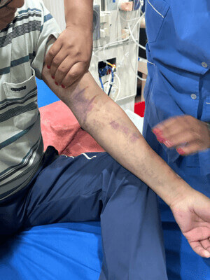 Man’s arm covered in bruises