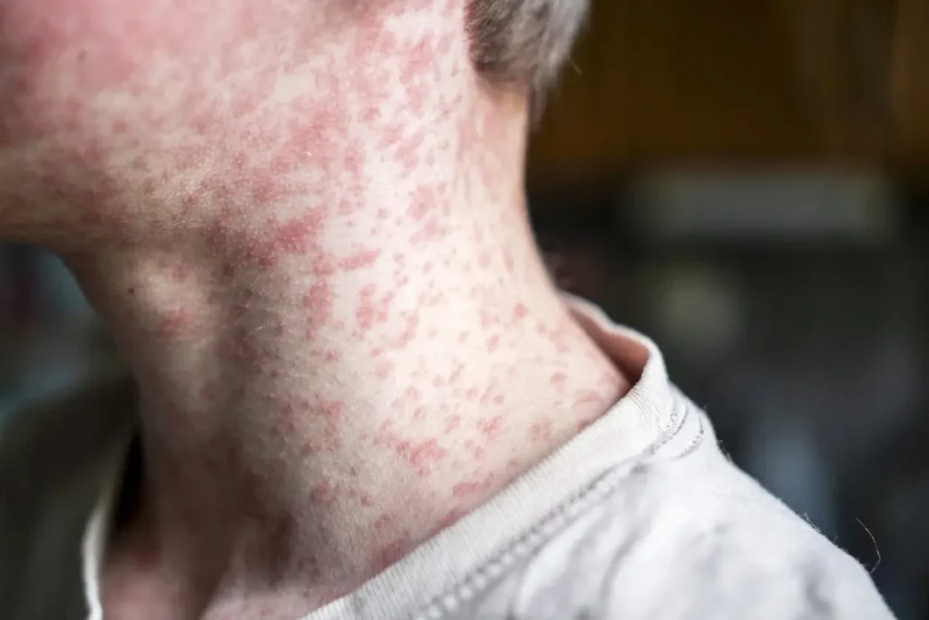 Measles rash on the boy’s neck measles outbreaks