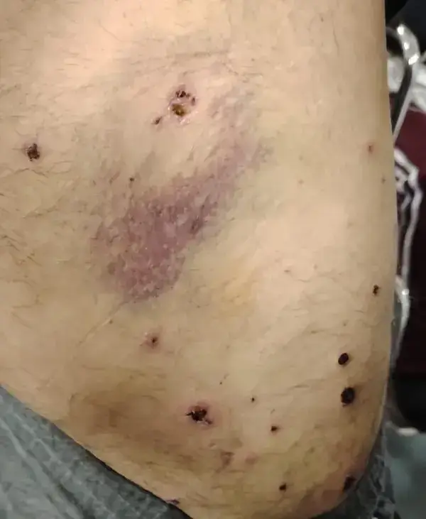 A survivor’s injuries from the boat strike